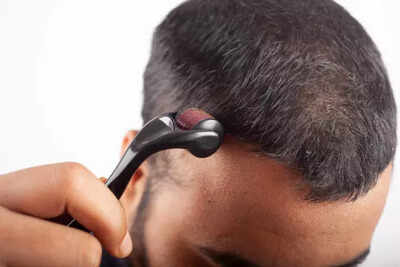 Hair Growth: How to use Derma Roller to grow hair on bald patches |