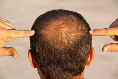 Hair Regrowth Oil: How to use Coconut Oil to regrow hair on a bald patch |