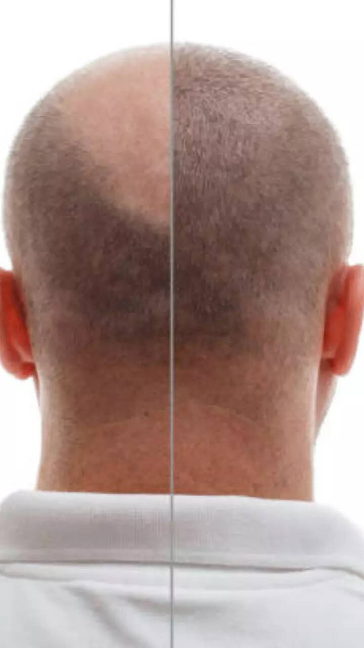 10 easy tips to regrow hair on your scalp