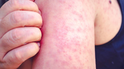 Measles cases in the US cross 1,000: Early symptoms, prevention tips to know