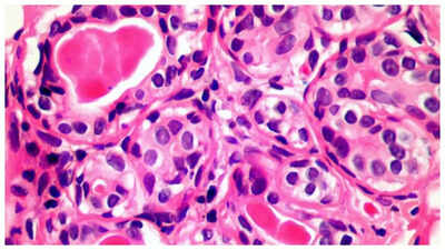 Can a Plutonium leak cause Cancer?