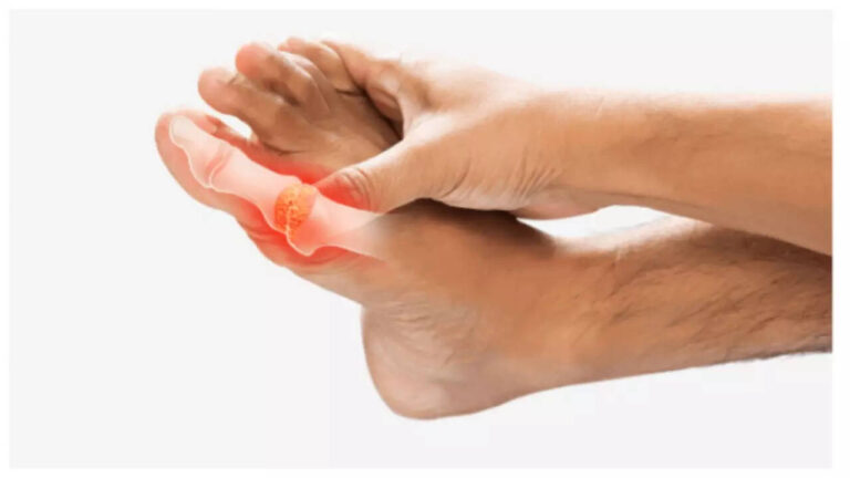 5 symptoms of high uric acid that often go unnoticed and how it can impact your kidneys