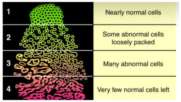 Prostate Cancer: What is the Gleason score in prostate Cancer and why early testing is crucial |