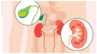 Kidney Stones vs Gallbladder Stones: What is the difference and which is more difficult to treat
