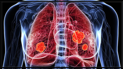 Lung Cancer Symptoms: 6 early symptoms of Lung Cancer that are easily ignored |
