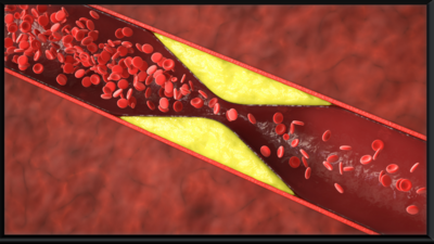 High Cholesterol Symptoms: 5 silent symptoms of high cholesterol that may go unnoticed |