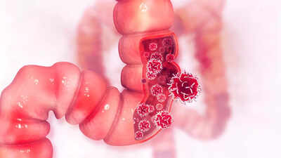 Colon Cancer: More powerful than pills? How this common practice helped colon cancer survivors live longer |