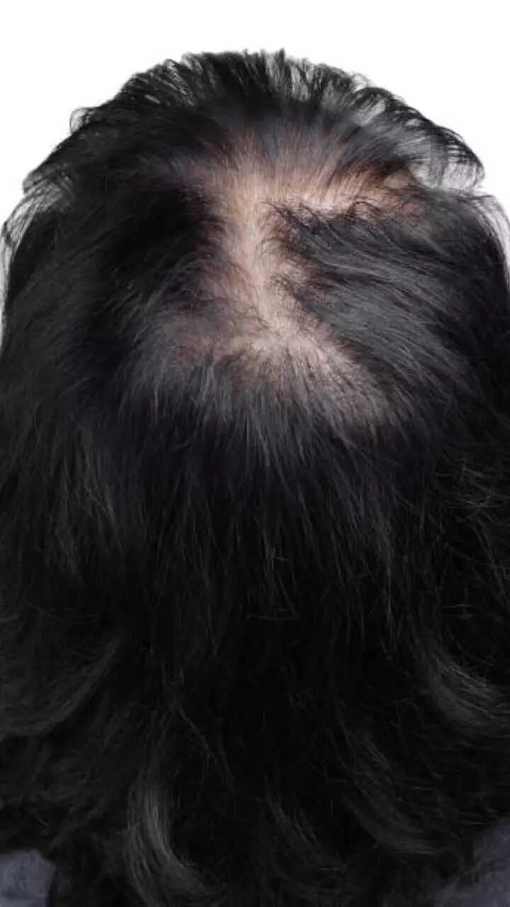 How you can grow hair on bald patches at home