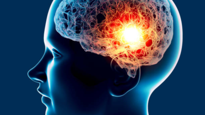 Brain aneurysms are silent killers—here’s why