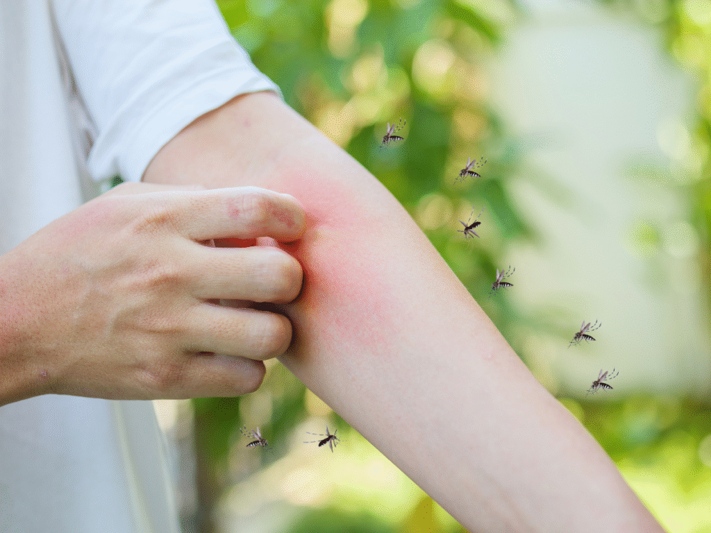 Itch, fever, or worse? Can mosquito bites trigger severe allergic reactions as well?