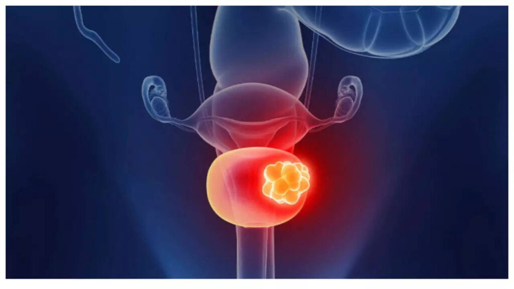 5 subtle symptoms of Bladder Cancer that are not noticeable at the beginning