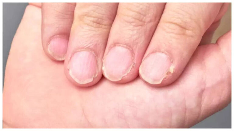5 diseases that nails can reveal