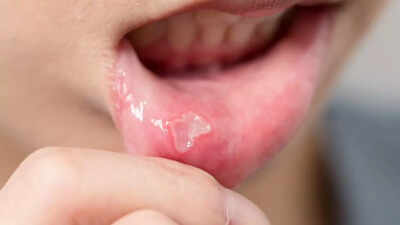 What is oral cancer: Know its symptoms, causes, and why early detection may save your life |