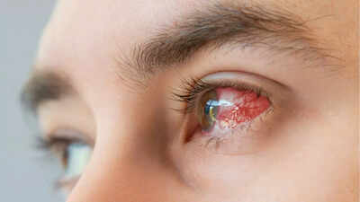 What causes conjunctivitis? Symptoms, types, and treatment you should know |