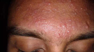 Monsoon skincare: 5 DIY face masks and scrubs to treat common skin problems this rainy season |