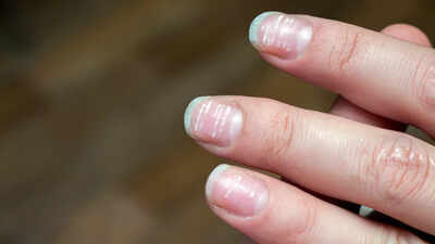 What are the tiny white spots on the nails? Top functional medicine doc says it could be a warning sign |