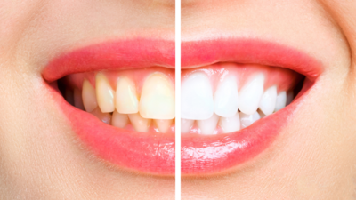 How to remove yellow stains from teeth: 3 tips that always work