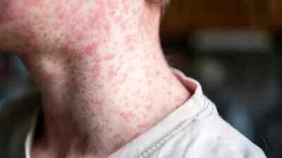Measles outbreak in US: Causes, warning signs and how to prevent it |