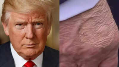 Donald Trump diagnosed with chronic venous insufficiency, White House says amid speculations over bruises on his hand