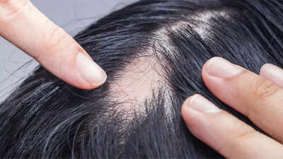 Alopecia Areata home remedies: What works, what doesn’t, and what to avoid |