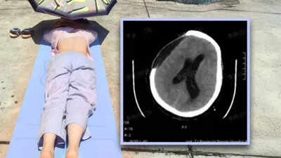 Chinese woman suffers brain hemorrhage, slips into coma after sunbathing during extreme heatwave; know the safe limit and health risks |
