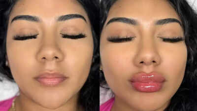 Are lip fillers safe and effective? Know the risks and what to consider before you try |
