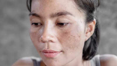 Understanding hyperpigmentation: Causes, types, prevention tips and more |