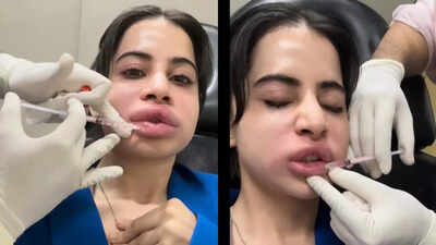 Lip fillers gone wrong or normal side effect? Expert breaks down Uorfi Javed’s swollen lips