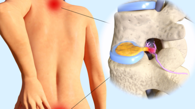 Disc Herniation: 4 exercise that can bring relief |