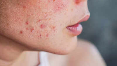How to know if your acne is actually a fungal infection: What is fungal acne, its causes, symptoms, and more |
