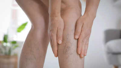 5 Warning signs of vein disease that could point to serious health issues |