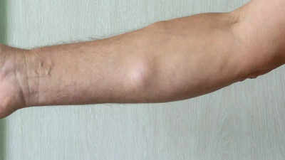 Soft lump under your skin? It might be a lipoma: Here’s what you need to know all about lipomas |