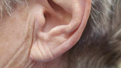 Heart Attack Symptoms: Earlobe crease a sign of a heart attack or stroke? Expert weighs in |