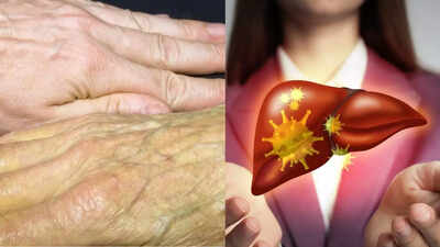 5 skin symptoms of liver disease that you should never ignore, according to a Harvard expert |