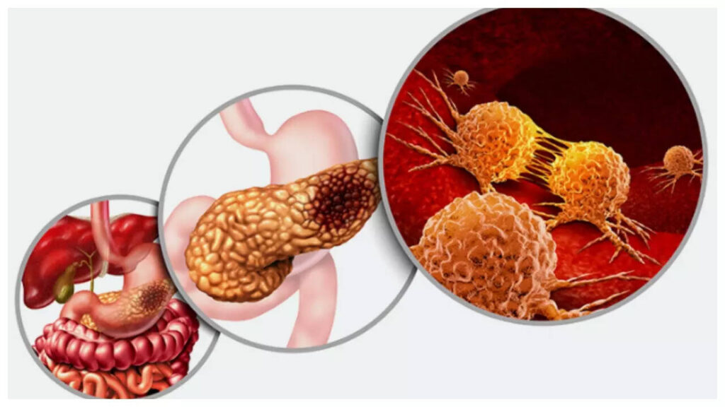 5 early signs of Pancreatic Cancer that are easy to ignore