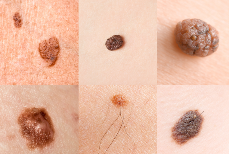 5 Early Signs of Skin Cancer That Are Easy to Miss