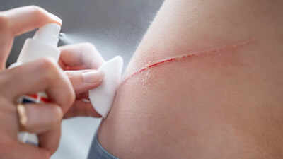 Can scratch can cause THIS deadly brain infection |