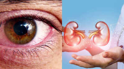 Don’t ignore these 5 eye symptoms, as they could point to kidney disease |