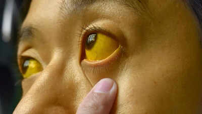 Jaundice, the yellowing of skin and eyes: Why it happens |
