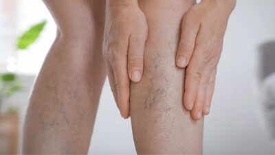 Are varicose veins a sign of poor blood circulation? Here’s what you need to know |