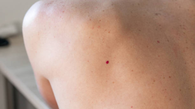 Cherry angiomas: Are those red bumps on your skin linked to cancer or liver diseases? |