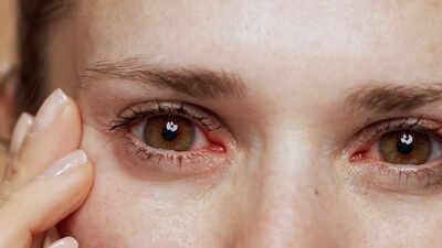 How to protect your eyes from infection this monsoon: 10 effective tips |