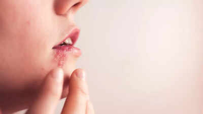 Herpes virus triggers mood disorders through neurological impact |