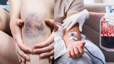 Blood cancer symptoms: Unexplained bruising and shoulder pain could be a sign of serious health risk |