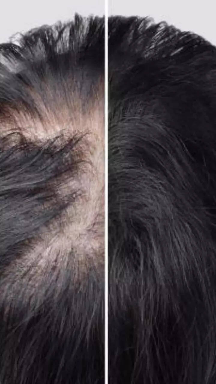 How to massage bald spots with oil for quick hair regrowth