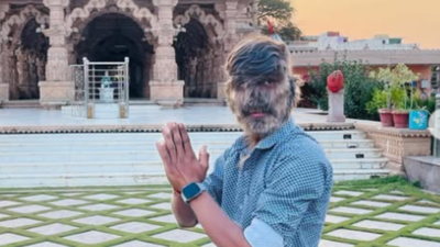 Meet Lalit Patidar: The Indian teen who suffers from the werewolf syndrome