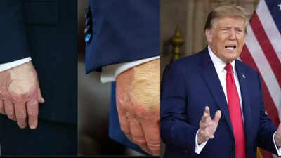 US President Donald Trump spotted with hand makeup again and swollen ankles, raising public concern over his chronic venous insufficiency condition | World News