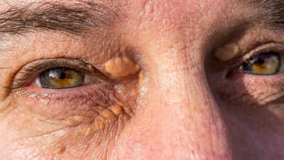 High cholesterol signs that appear on your skin before a heat test |