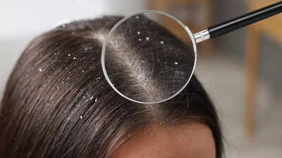 What is sticky, oily dandruff: Know its causes, why regular shampoo fails, and how to manage |