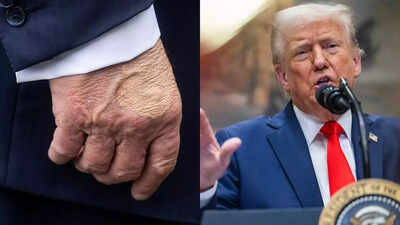 Trump’s health drama: Mystery bruise and swollen ankles – What the White House isn’t saying